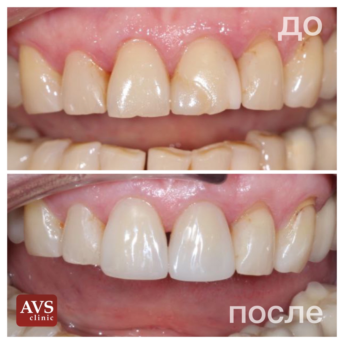 Процесс реставрации зуба