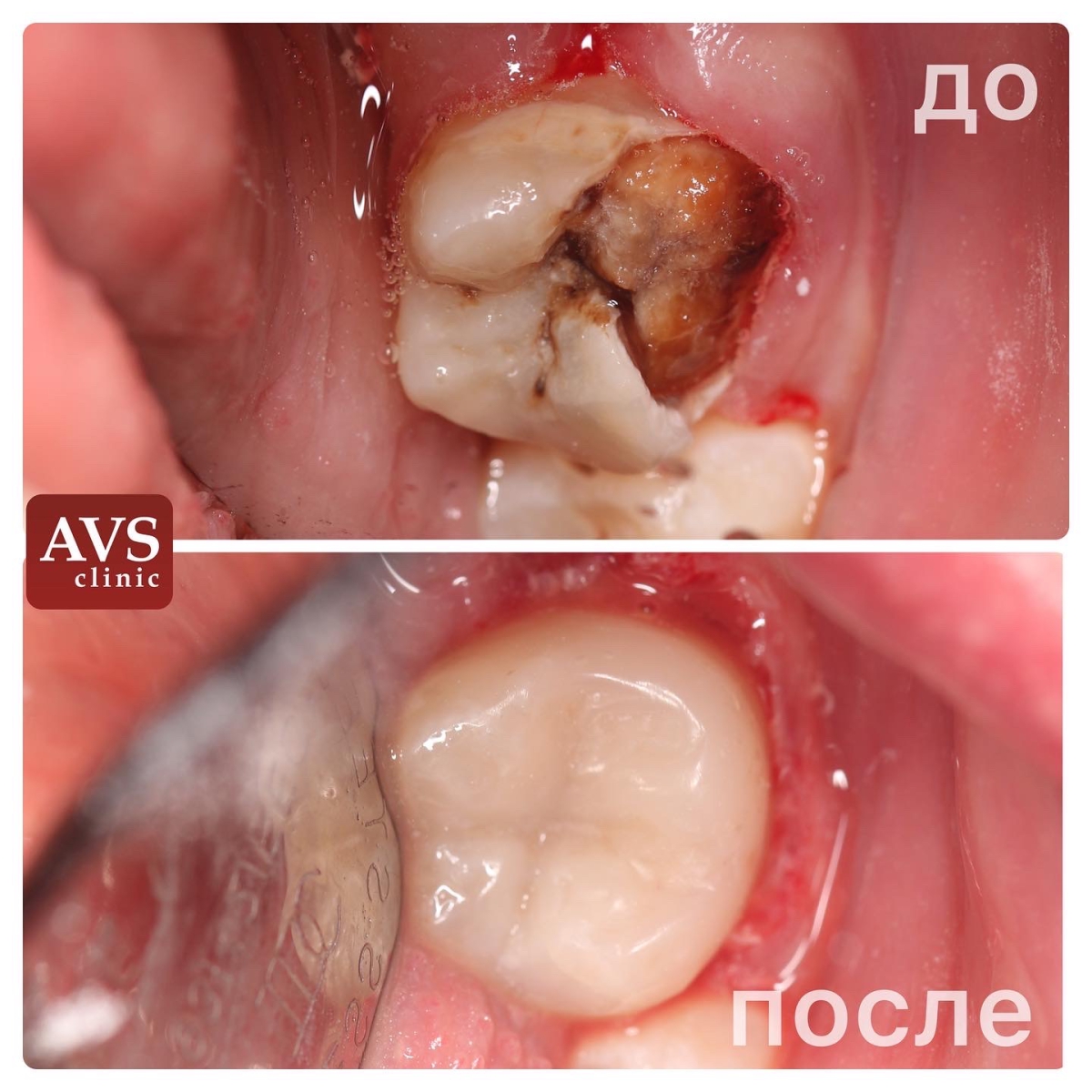 Результаты реставрации зуба