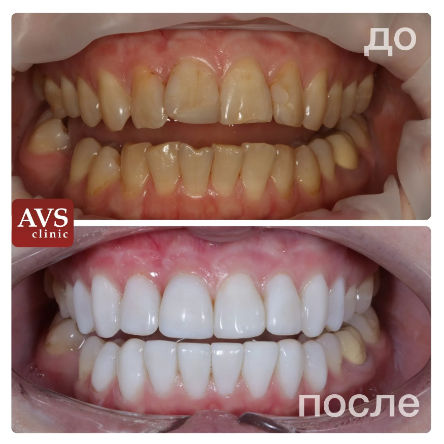 Фото реставрации зубов до после