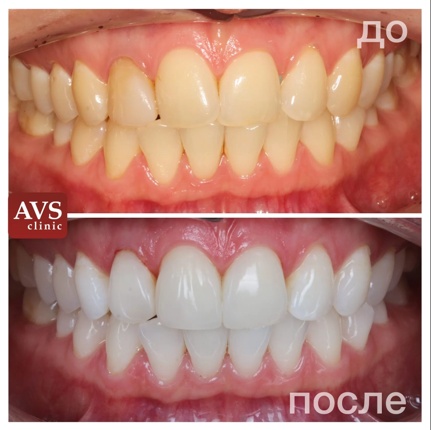 реставрация передних зубов до после