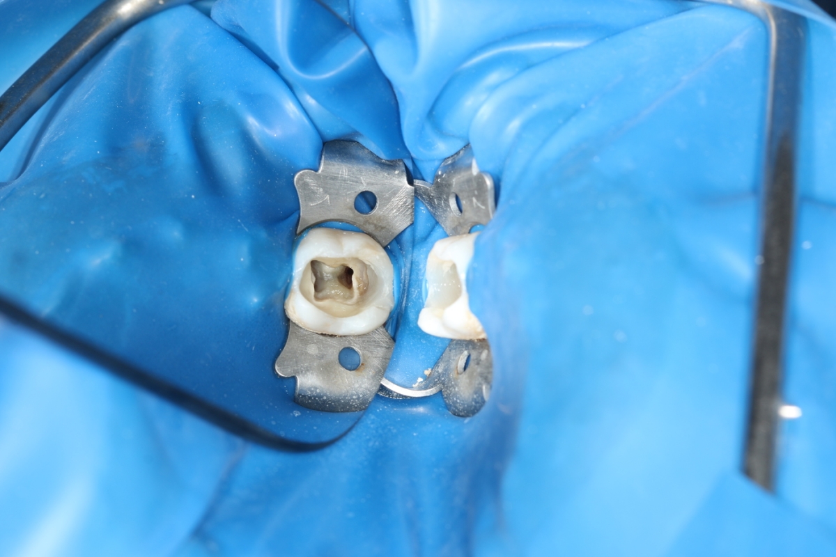 Этапы лечения каналов зуба